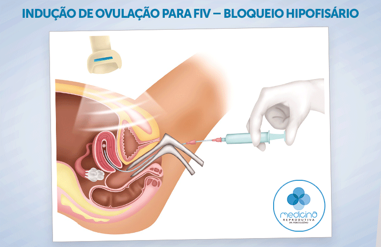 Cirurgia Reprodutiva (Antigo) - Fertilivitá Reprodução Humana